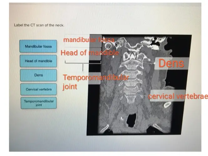Label the CT scan of the neck. Mandibular fossa Head of mandible Dens Cervical vertebra Temporomandibular joint