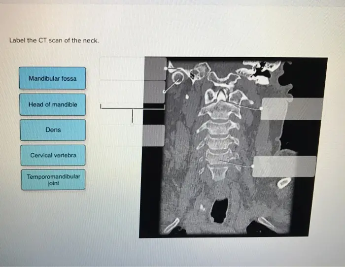 Label the CT scan of the neck. Mandibular fossa Head of mandible Dens Cervical vertebra Temporomandibular joint